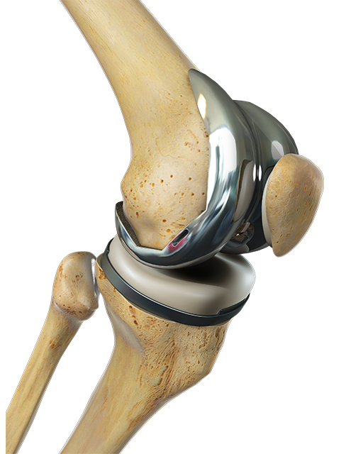 Considering joint replacement surgery? - Capital City Surgery Center ...